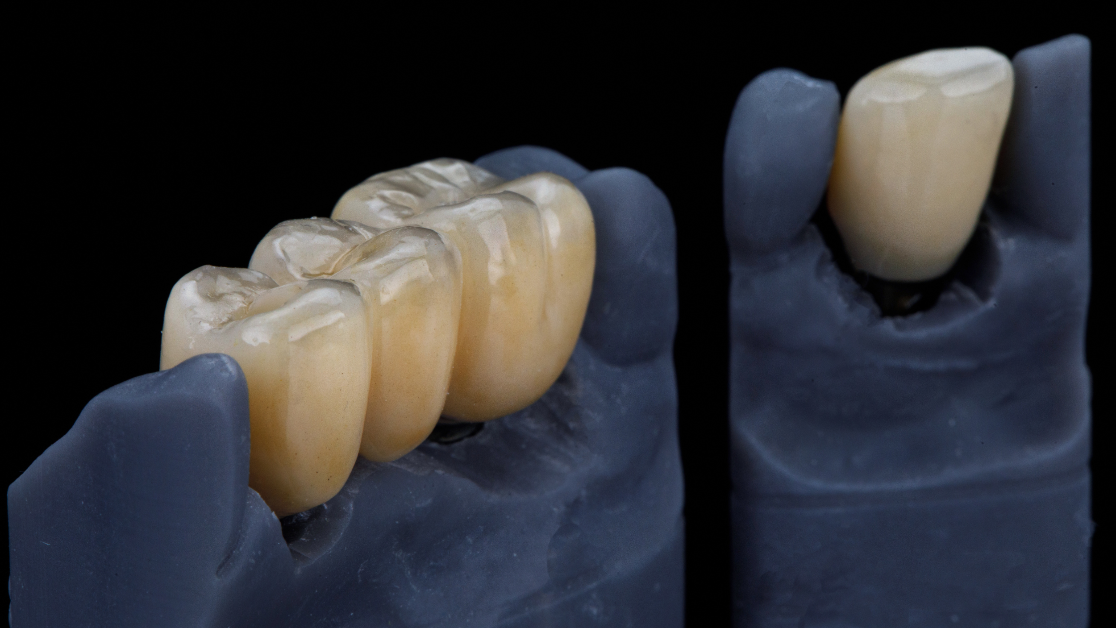 dental crowns (6)